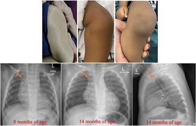 Case Report: A Case of Leukocyte Adhesion Deficiency, Type III Presenting With Impaired Platelet Function, Lymphocytosis and Granulocytosis